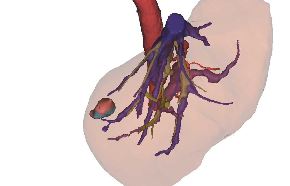 3D models of tumor and great vessels obtained via ultrasound (respectively in pink and purple) are merged with 3D models obtained via CT (respectively in green and khaki) and show accuracy of ultrasound reconstruction