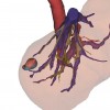 3D models of tumor and great vessels obtained via ultrasound (respectively in pink and purple) are merged with 3D models obtained via CT (respectively in green and khaki) and show accuracy of ultrasound reconstruction